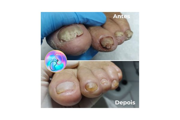 Foto de antes e depois do tratamento 32